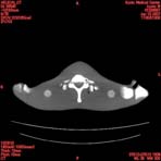 PBU CT Scan Torso Slice
