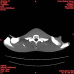 PBU CT Scan Torso Slice