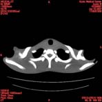 PBU CT Scan Torso Slice