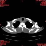 PBU CT Scan Torso Slice
