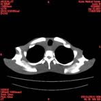 PBU CT Scan Torso Slice