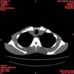PBU CT Scan Torso Slice