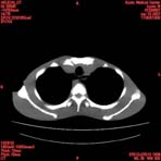 PBU CT Scan Torso Slice