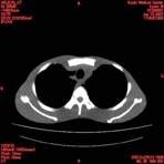 PBU CT Scan Torso Slice