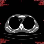 PBU CT Scan Torso Slice