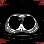 PBU CT Scan Torso Slice