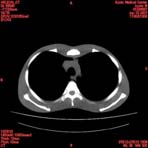 PBU CT Scan Torso Slice