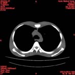 PBU CT Scan Torso Slice