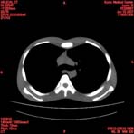 PBU CT Scan Torso Slice