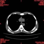 PBU CT Scan Torso Slice