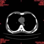 PBU CT Scan Torso Slice