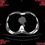 PBU CT Scan Torso Slice