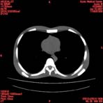 PBU CT Scan Torso Slice
