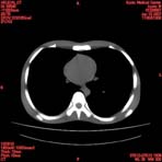 PBU CT Scan Torso Slice