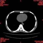 PBU CT Scan Torso Slice