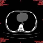 PBU CT Scan Torso Slice
