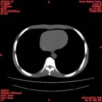 PBU CT Scan Torso Slice