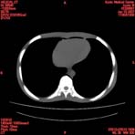 PBU CT Scan Torso Slice