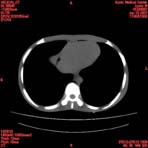 PBU CT Scan Torso Slice
