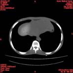 PBU CT Scan Torso Slice