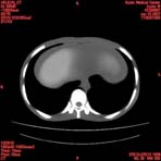 PBU CT Scan Torso Slice