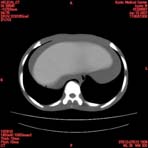 PBU CT Scan Torso Slice