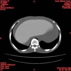 PBU CT Scan Torso Slice