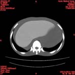 PBU CT Scan Torso Slice