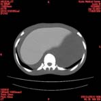 PBU CT Scan Torso Slice