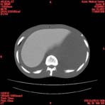 PBU CT Scan Torso Slice
