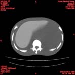 PBU CT Scan Torso Slice