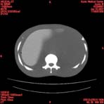 PBU CT Scan Torso Slice