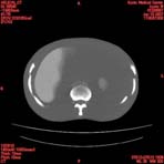 PBU CT Scan Torso Slice