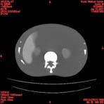 PBU CT Scan Torso Slice