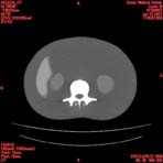 PBU CT Scan Torso Slice