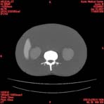 PBU CT Scan Torso Slice