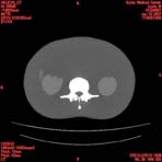 PBU CT Scan Torso Slice