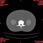 PBU CT Scan Torso Slice