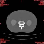 PBU CT Scan Torso Slice