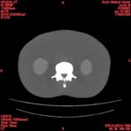 PBU CT Scan Torso Slice