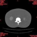 PBU CT Scan Torso Slice