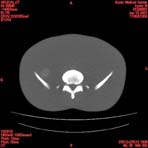 PBU CT Scan Torso Slice