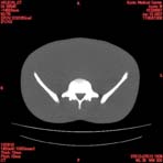 PBU CT Scan Torso Slice