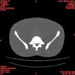 PBU CT Scan Torso Slice