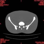 PBU CT Scan Torso Slice