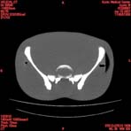 PBU CT Scan Torso Slice