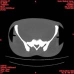PBU CT Scan Torso Slice