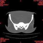 PBU CT Scan Torso Slice