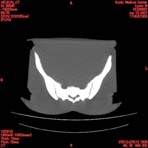 PBU CT Scan Torso Slice