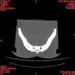 PBU CT Scan Torso Slice